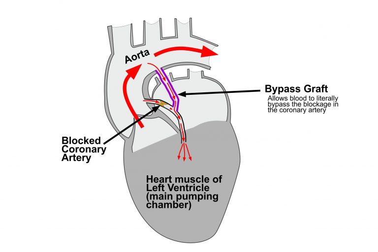 image Diagram explaining coronary artery bypass grafting