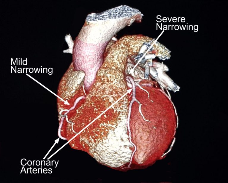 image CT Coronary angiography