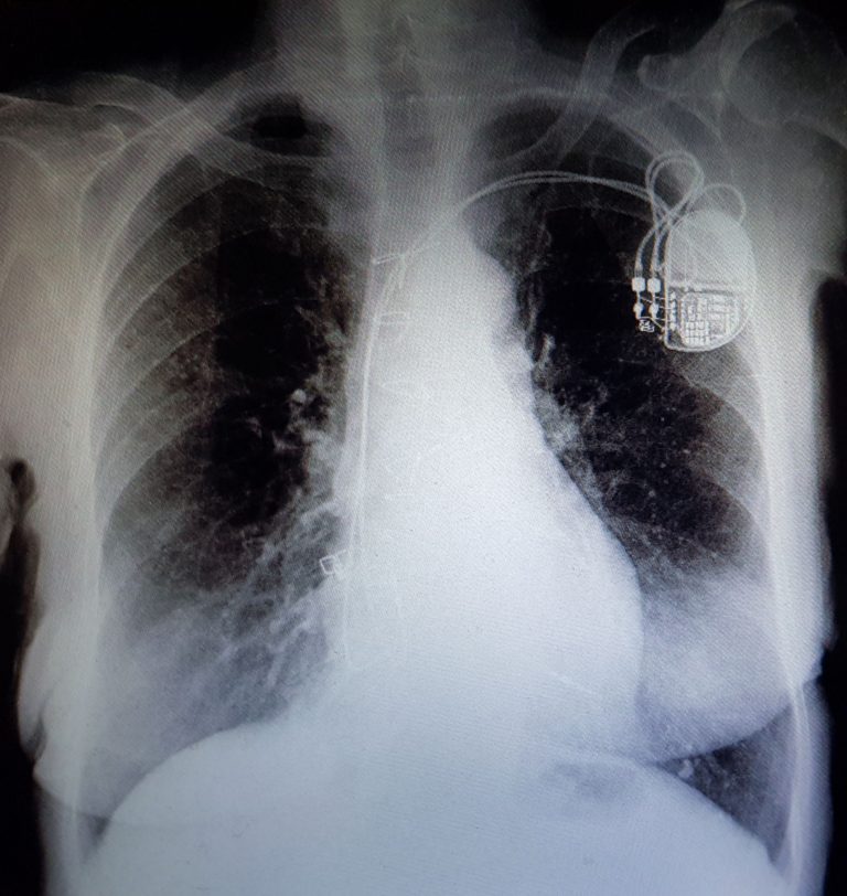 Chest X-ray showing a pacemaker with leads going down the veins into the heart