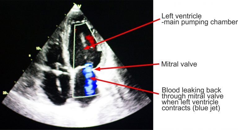 image Echocardiogram showing mitral regurgitation