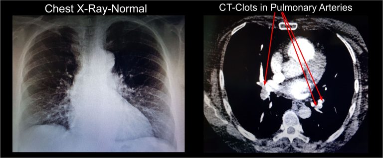 image Plumonary emboli-CXR and CTPA