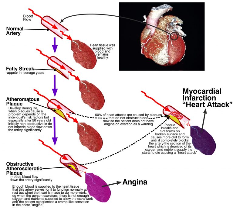 Mechanism of occurrence of angina and heart attacks